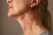 Image result for Rhus Dermatitis