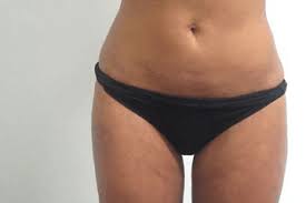 Liposuctie In Belgie Abc Clinic