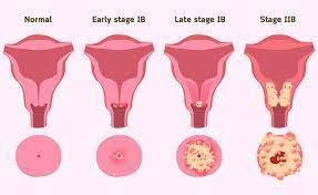 In almost all cases, cervical cancer is the result of a change in cell dna caused by the human papillomavirus (hpv). Cervical Cancer Causes Symptoms Treatment Parkway East Hospital