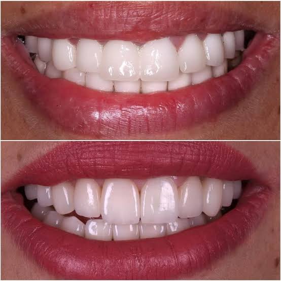 Emax veneers