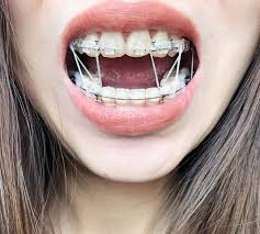 Braces Colors Black And Blue Braces Girlswithbraces Clearbraces Elastics Powerchain Braces Girls Dental Braces Braces Colors