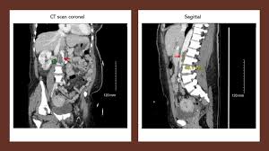 Image result for Renal Infarction