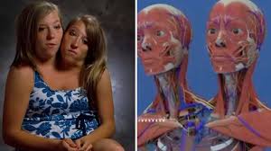 Conjoined twins Abby and Brittany Hensel leave fans in disbelief as they  reveal how their bodies are connected