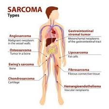 Learn more about the symptoms, risk factors, diagnosis, types, treatment, and outlook for bone cancer. Cancer Fighting Lifestyle 5 Facts To Know About Sarcoma Nfcr