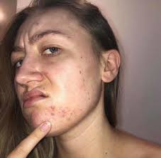Skin specialist who feared clients would ignore her advice because of her  severe acne runs successful business after finding “holy grail” for her  complexion