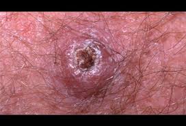 One type is called squamous cell carcinoma. Merkel Cell Carcinoma Picture Image On Medicinenet Com