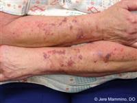 Purpura is the name given to the discolouration of the skin or mucous membranes due to haemorrhage from small blood vessels. Bruising Hands And Arms American Osteopathic College Of Dermatology Aocd