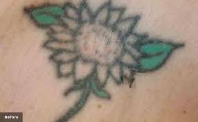 We estimate three to five sessions to fade for a cover up piece and ten to twelve sessions for full removal based on tattoo colors and sizing. Tattoo Removal Fayetteville Nc Tattoo Design