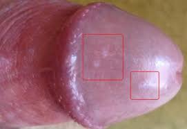 Vorbeugende Massnahmen Und Behandlungsmethoden Ursachen Und Behandlung Von Weissen Flecken Auf Dem Penis