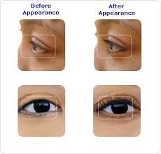 Bio Oil Before After Acne Scars Pin On Eyelashes Eyeshadow Eyelashproducts