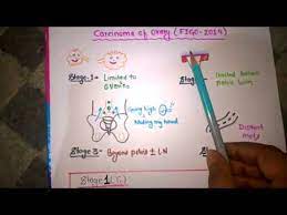 Staging classification for cancer of the ovary, fallopian tube, and peritoneum. Ovarian Carcinoma Staging Picmonics Youtube