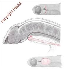 Image result for Chordee