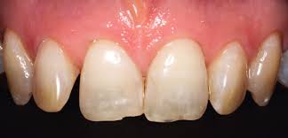 Fluoroseflecken Auf Den Zahnen Behandeln Dentalmagazin De