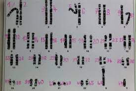 According to lejeune's laboratory notebooks, he made the observation demonstrating the link on 22 may 1958. Touchdown 21 Ist Trisomie 21 Dasselbe Wie Das Down Syndrom
