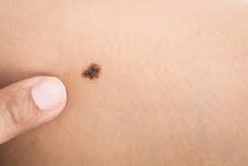 A normal mole has a clear and distinct border, whereas cancerous moles (melanomas) often exhibit blurred or jagged edges. Here S How To Check If Your Mole Is Cancerous Health The Jakarta Post