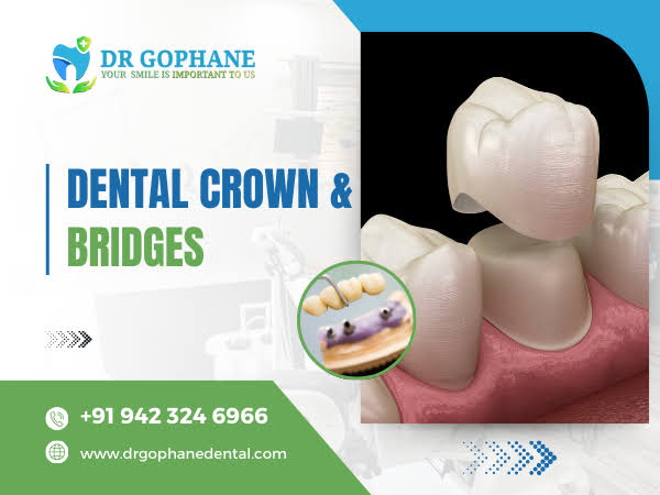 Dental Crown & Bridges In Yavatmal product image