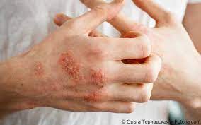 Atopisches ekzem, infantiles ekzem, prurigo besnier, allergisches. Atopische Dermatitis Metaanalyse Zu Krebsrisiko Gelbe Liste