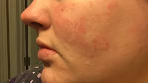 Skin Concerns Personal Is This Ringworm On My Cheek Imgur While it's not too worrying, as a. skin concerns personal is this