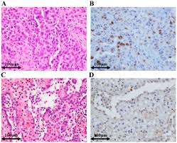 Maybe you would like to learn more about one of these? Utility Of Survivin Bap1 And Ki 67 Immunohistochemistry In Distinguishing Epithelioid Mesothelioma From Reactive Mesothelial Hyperplasia