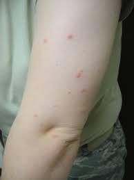 Typically, bites tend to occur on areas exposed during sleeping, such as clean heavier bedding items, including mattresses, pillows, comforters, and duvet covers, using high heat, ideally the dry steam setting available on modern. Not Letting Bedbugs Bite Becoming Harder To Do