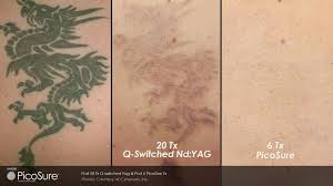 Obviously, if you have less reduction after a session then potentially you will need more laser tattoo removal sessions creating more skin fatigue on the treated area. Tattoo Removal Sydney Kat Laser Salon