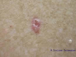 Ear cancer can affect both the inner and external parts of the ear. Skin Cancer And Pigmented Skin Lesions Ioulios Palamaras Md Phd