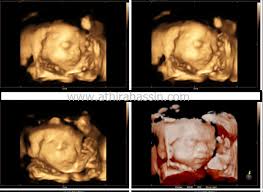 Scan jantina bayi perlu dilakukan bagi mendapatkan pengesahan namun sejauh mana ketepatannya? Beza Scan Baby 2d 3d 4d 5d Dan Hd Athirahassin