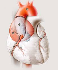 Das Aneurysma Der Aorta Ascendens Eine Zeitbombe Hirslanden