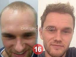 نتائج عملية زراعة الشعر في تركيا بعد 8 اشهر زراعة 4500 بصيلة شعر بتقنية الاقتطاف 00905444488340 www camiliaclinic com hair transplant hairsty