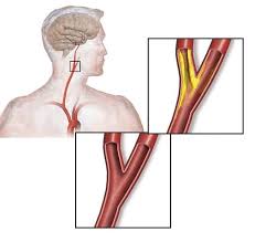 Image result for carotid artery