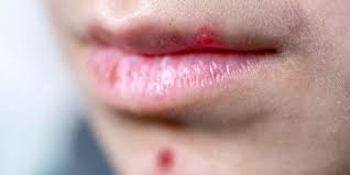 Use a cotton swab to apply the aloe vera gel to the popped pimple. Pimple On Lip Causes Treatment And Prevention
