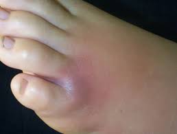 To help identify the type of spider bite you have, capture the spider or take a photo with your phone. Spider Bite Dermnet Nz