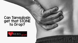 Kidney Stone Archives Rebel Em Emergency Medicine Blog
