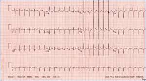 This is manifested as an upright p wave in lead ii of the ecg. Pediatric Ekg Interpretation
