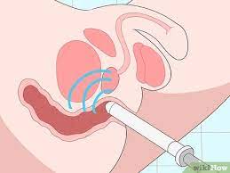 3 Ways To Prevent Perianal Abscess From Returning Wikihow