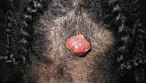 Image result for Pyogenic Granuloma