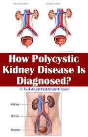 Pin On Chronic Kidney Disease