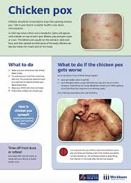 But the good news is that a vaccine can prevent most cases. Chicken Pox Week 4 Term 3