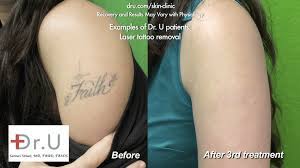 Inland empire tattoo removal is a service of jwr wellness clinics where dr. Video Dr U Answers Your Questions Tattoo Removal With Laser La