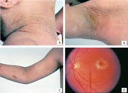 Sjogren Larsson Syndrome Molecular Genetics And Biochemical Pathogenesis Of Fatty Aldehyde Dehydrogenase Deficiency Sciencedirect