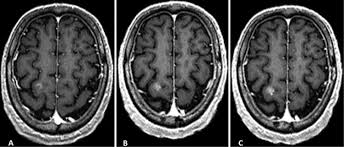 3 mri brain and pituitary both with and without contrast. Time Delayed Contrast Enhanced Mri Improves Detection Of Brain Metastases And Apparent Treatment Volumes In Journal Of Neurosurgery Volume 124 Issue 2 2016