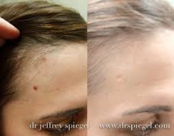Recent expert opinion and observational evidence suggests that seven. Mole Removal Boston Skin Growth Removal Ma