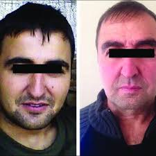 PDF) A case of Marshall′s syndrome (postinflammatory elastolysis)