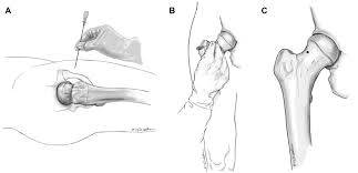 Image result for Hip Injection