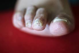 This usually occurs after these organisms in order to confirm a toenail fungus, your doctor will first evaluate your feet. Explainer Why Do We Get Fungal Nail Infections And How Can We Treat Them