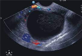Ovarian cancer starts in the cells lining the ovaries. Sonographic Assessment Of Ovarian Cysts And Masses Chapter 8 Gynaecological Ultrasound Scanning