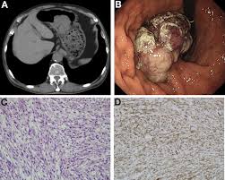 Image result for Leiomyosarcoma