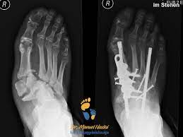 Also called charcot joint or neuropathic joint, charcot arthropathy is a progressive condition of the musculoskeletal system that is characterized by joint dislocations, pathologic fractures, and. Charcot Fuss Diabetischer Fuss Mit Spontanbruchen Bei Polyneuropathie