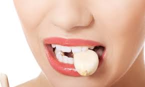 Nov 11, 2020 · screws that come loose can be tightened and chips in the crowns can be polished. Can A Permanent Loose Teeth Tighten Back Up Teethwalls