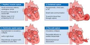 Image result for Myocardial Infarction Stabilization